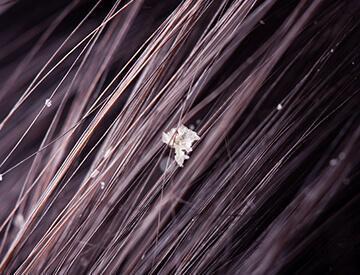 Best dandruff treatment in Dubai - Dr Batra’s Homeopathy