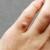 Proven Warts Treatment & Removal In Dubai | Dr Batra’s Homeopathy