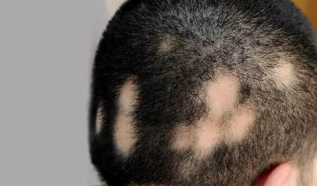Best Homeopathic Alopecia Treatment For Men & Women - Dr Batra’s Homeopathy