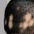Best Homeopathic Alopecia Treatment For Men & Women - Dr Batra’s Homeopathy